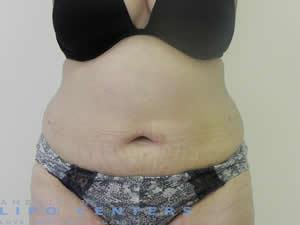 americanlipocenters_310.jpg
